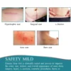 Silicone Scar Tape Skin Cover & Repair - Image 18